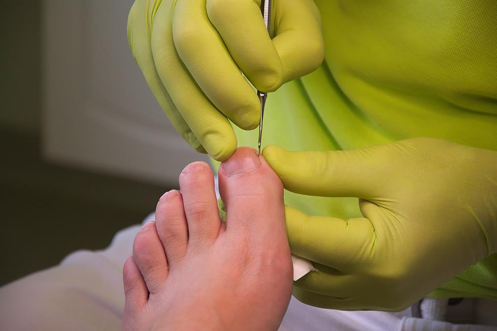 Ingrown Toenail Specialist in Quincy MA | Foot Care Specialists, PC